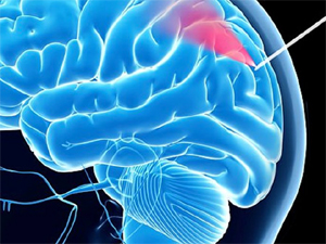 Beyin biopsiyası üçün kameralı ağıllı iynə yaradılıb