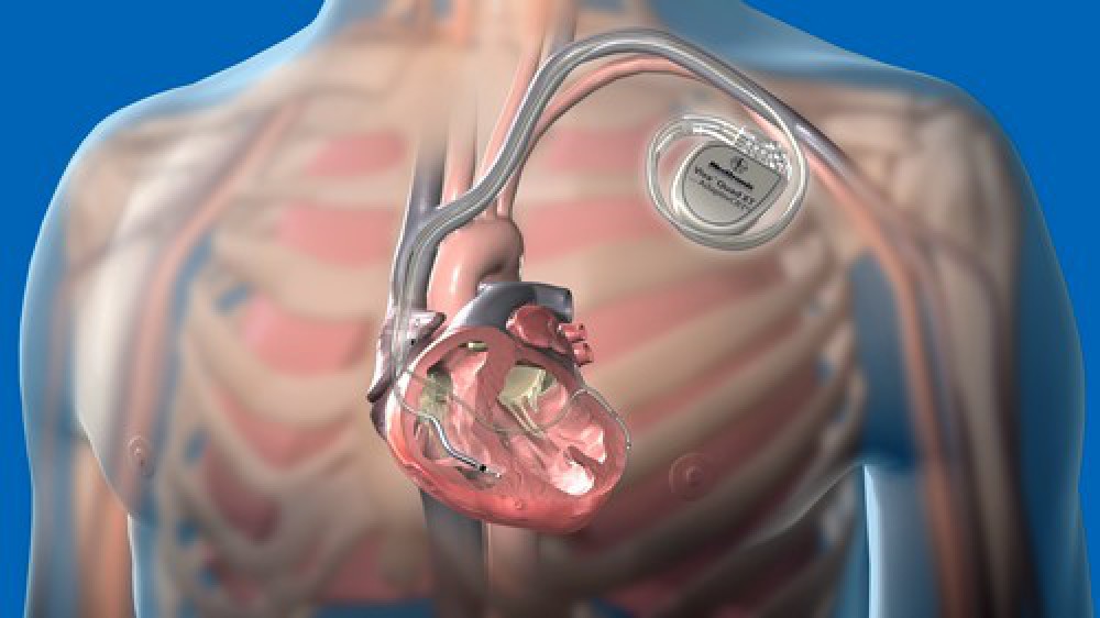 Dünyada ən kiçik kardiostimulyator uğurla implantasiya olunub