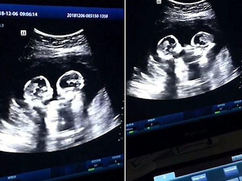 12 неделя 24 года. УЗИ двойни на 20 неделе беременности. УЗИ 12 недель беременности двойня. УЗИ 15 недель беременности двойня. Двойняшки на УЗИ 12 недель беременности.