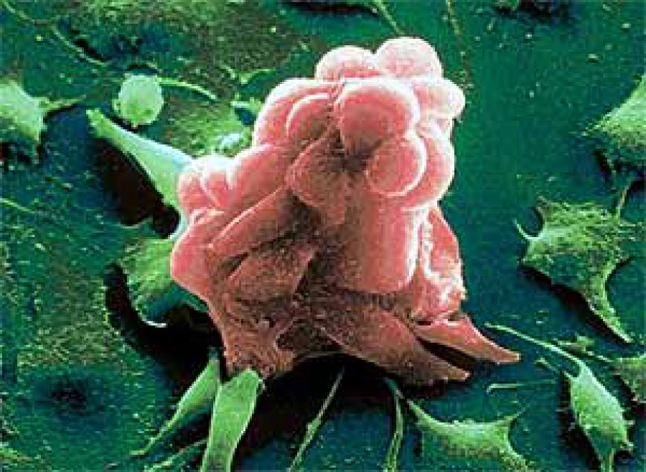 Bəzi xərçəng növlərinin müalicəsində antibiotiklər mühüm rol oynayır